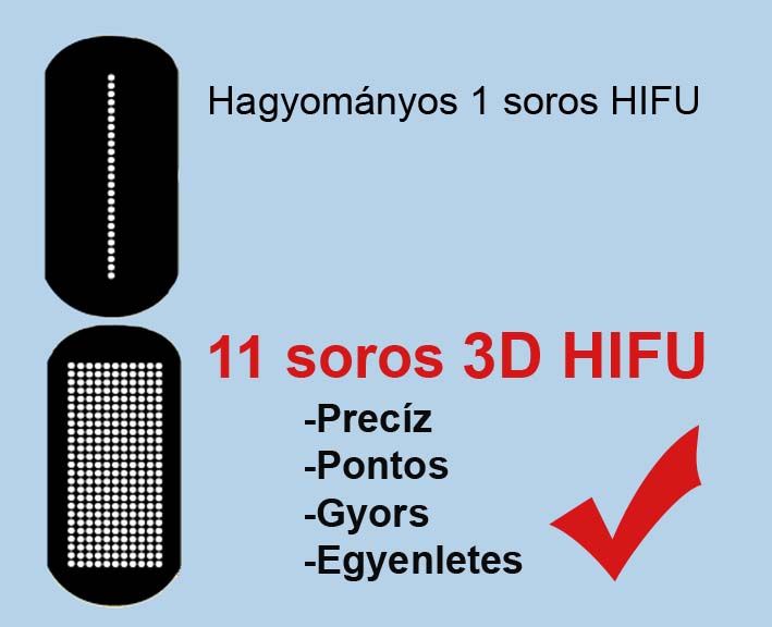 11 soros HIFU gép