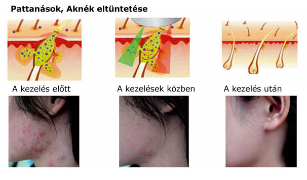 Akne - pattanásos bőr tünetei és kezelése